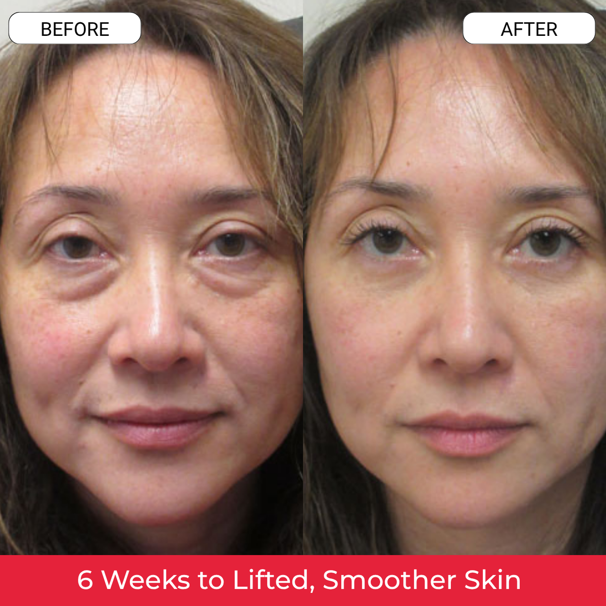 Before and after — tired eyes reduced in 6 weeks