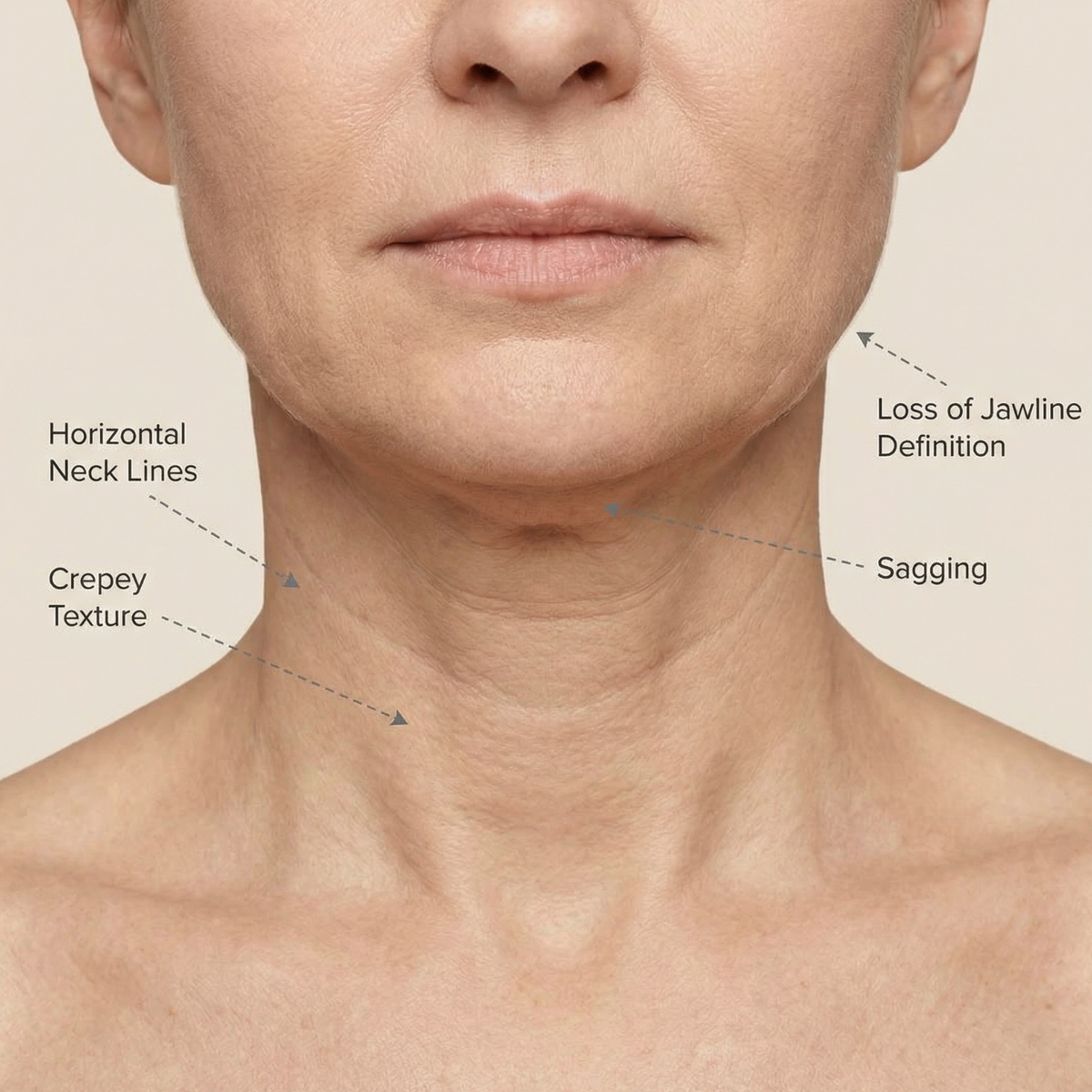 Multiple signs of neck aging