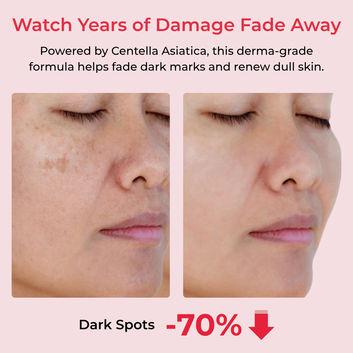 Before and after — dark spots and scars fading
